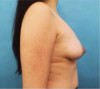 Breast Lift Patient #3 Before Photo Thumbnail # 1