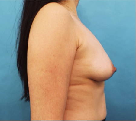Breast Lift Patient #3 Before Photo # 1