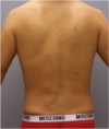 Liposuction Patient #26 After Photo Thumbnail # 8