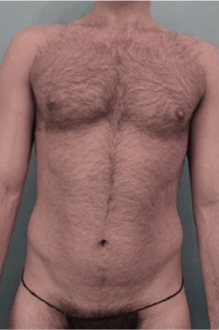 Before Image: Male Liposuction Patient #1