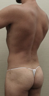 After Image: Male Liposuction Patient #1 -