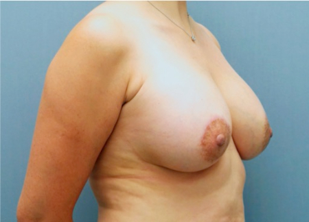 Breast Lift Patient #3 After Photo # 4