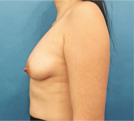 Breast Lift Patient #3 Before Photo # 5