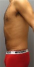 Male Liposuction Patient #3 After Photo Thumbnail # 6