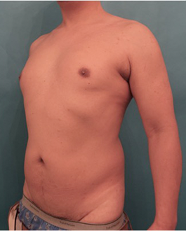 Male Liposuction Patient #5 Before Photo Thumbnail # 1