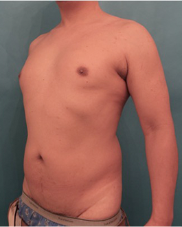 Male Liposuction Patient