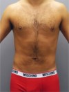 Male Liposuction Patient #3 After Photo Thumbnail # 2
