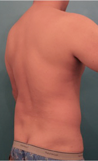 Male Liposuction Patient #5 Before Photo # 5