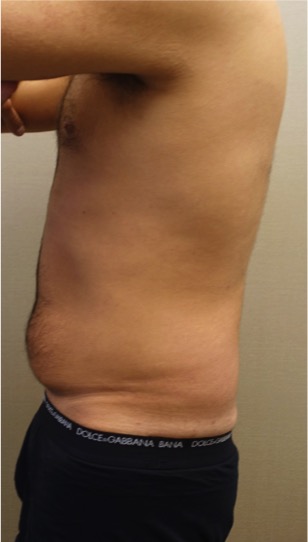 Liposuction Patient #26 Before Photo # 5