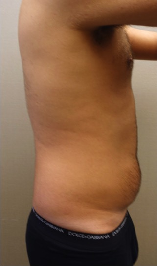 Male Liposuction Patient #3 Before Photo # 3