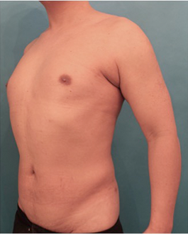 Male Liposuction Patient