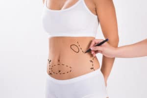  Liposuction NYC | Lipo Manhattan 