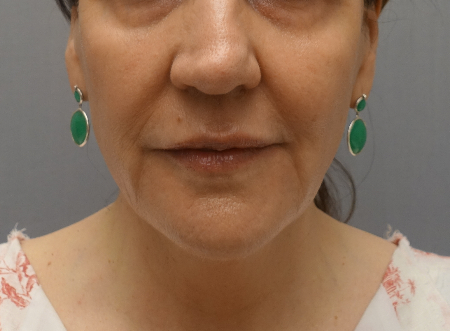 Jowl/Jawline Contouring Kybella Patient #1 After Photo # 2