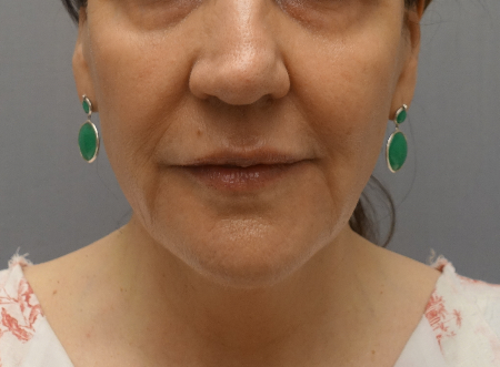 After Image: Jowl/Jawline Contouring Kybella Patient #1 - 