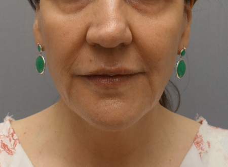 Kybella (Body Contouring) Patient