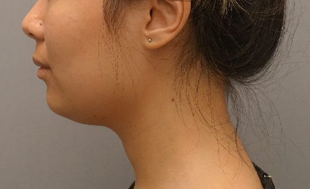 Kybella Patient #18 Before Photo # 9