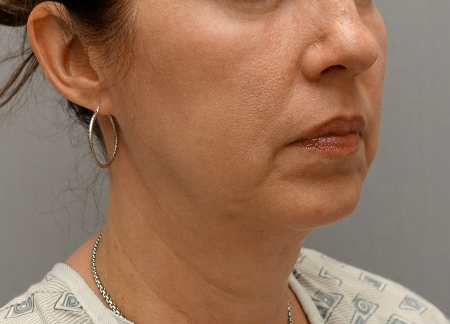 Jowl/Jawline Contouring Kybella Patient #6 After Photo Thumbnail # 4