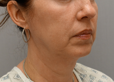 Jowl/Jawline Contouring Kybella Patient #6 After Photo # 4