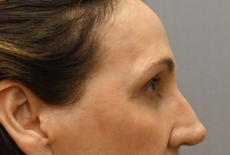 Upper and Lower Eyelid Blepharoplasty Patient #5 After Photo Thumbnail # 6