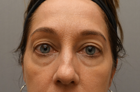 Lower Eyelid Blepharoplasty Patient #3 Before Photo # 1