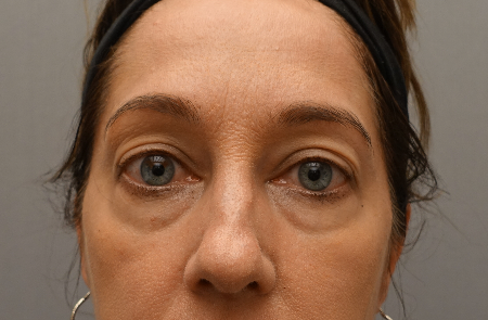 Blepharoplasty (Eyelid Lift) Patient