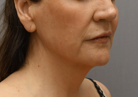 Jowl/Jawline Contouring Kybella Patient #1 After Photo # 10