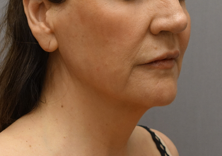 After Image: Jowl/Jawline Contouring Kybella Patient #1 -