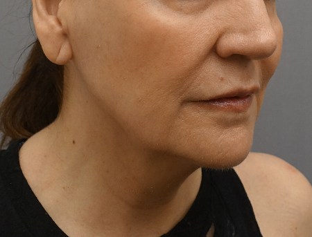 Before Image: Jowl/Jawline Contouring Kybella Patient #1 -