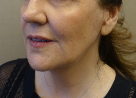 Before Image: Jowl/Jawline Contouring Kybella Patient #1 -