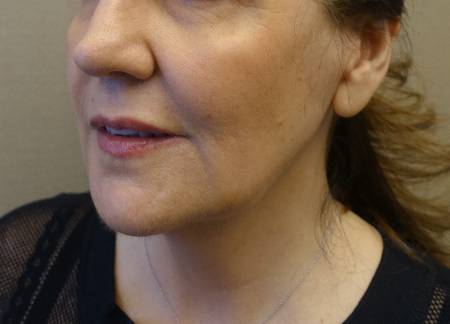 Jowl/Jawline Contouring Kybella Patient #1 Before Photo # 5