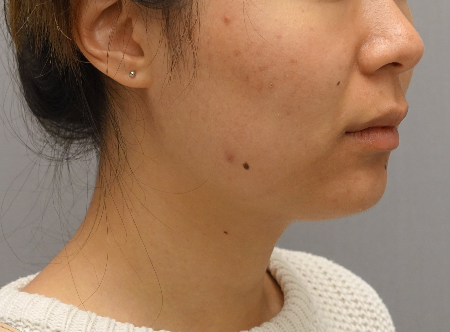 Kybella Patient #18 After Photo # 4