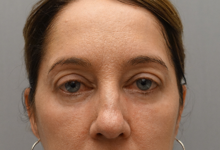 Lower Eyelid Blepharoplasty Patient #3 After Photo # 2