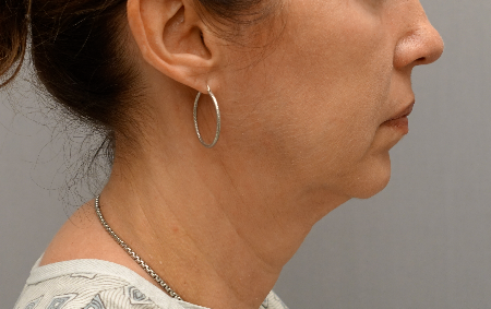 Jowl/Jawline Contouring Kybella Patient #6 After Photo # 10