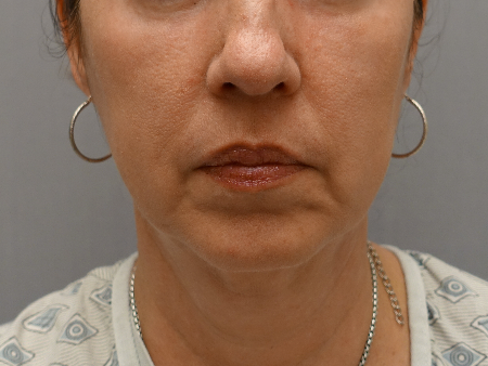 Jowl/Jawline Contouring Kybella Patient #6 After Photo # 2