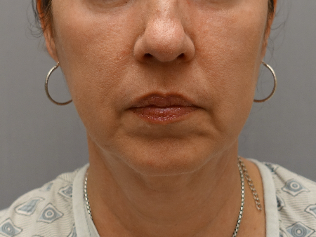 Kybella (Body Contouring) Patient