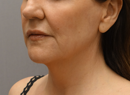 Jowl/Jawline Contouring Kybella Patient #1 After Photo Thumbnail # 6