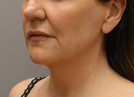 After Image: Jowl/Jawline Contouring Kybella Patient #1 -