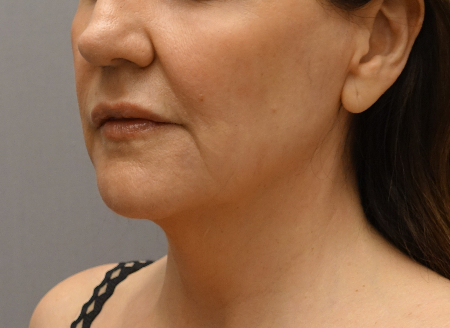 Jowl/Jawline Contouring Kybella Patient #1 After Photo # 6