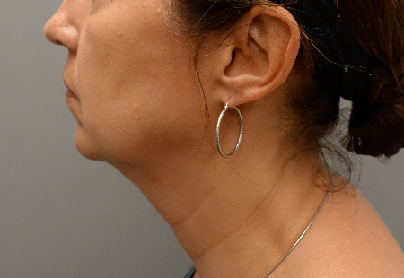 Jowl/Jawline Contouring Kybella Patient #6 Before Photo Thumbnail # 7