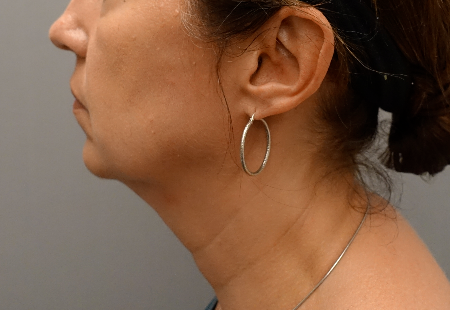 Jowl/Jawline Contouring Kybella Patient #6 Before Photo # 7