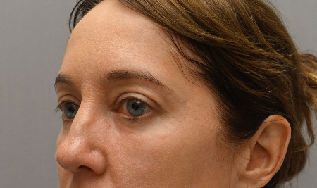 Lower Eyelid Blepharoplasty Patient #3 After Photo # 6
