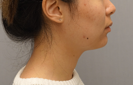 Kybella Patient #18 After Photo Thumbnail # 6