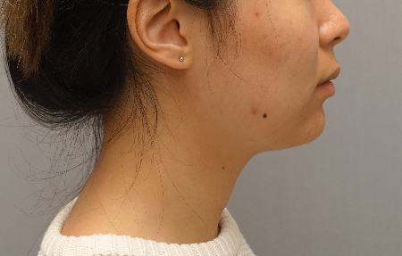 Kybella Patient #18 After Photo # 6