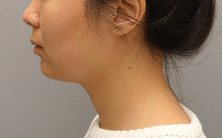 Kybella Patient #18 After Photo # 10