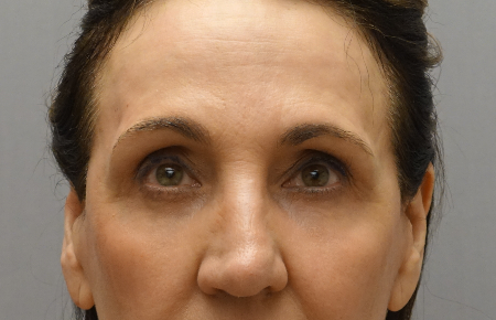 Upper and Lower Eyelid Blepharoplasty Patient #5 After Photo # 4