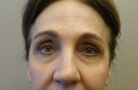 Upper and Lower Eyelid Blepharoplasty Patient #5 Before Photo # 1