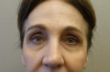 Blepharoplasty (Eyelid Lift) Patient