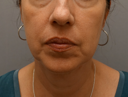 Jowl/Jawline Contouring Kybella Patient #6 Before Photo # 1
