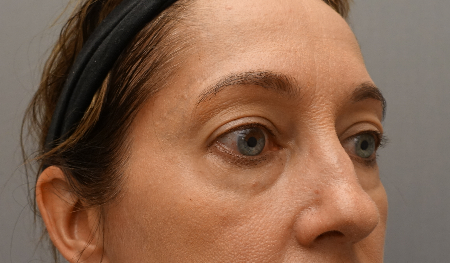 Lower Eyelid Blepharoplasty Patient #3 Before Photo Thumbnail # 3