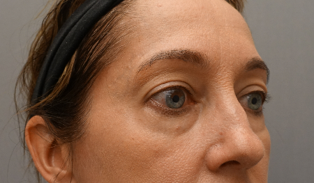 Lower Eyelid Blepharoplasty Patient #3 Before Photo # 3